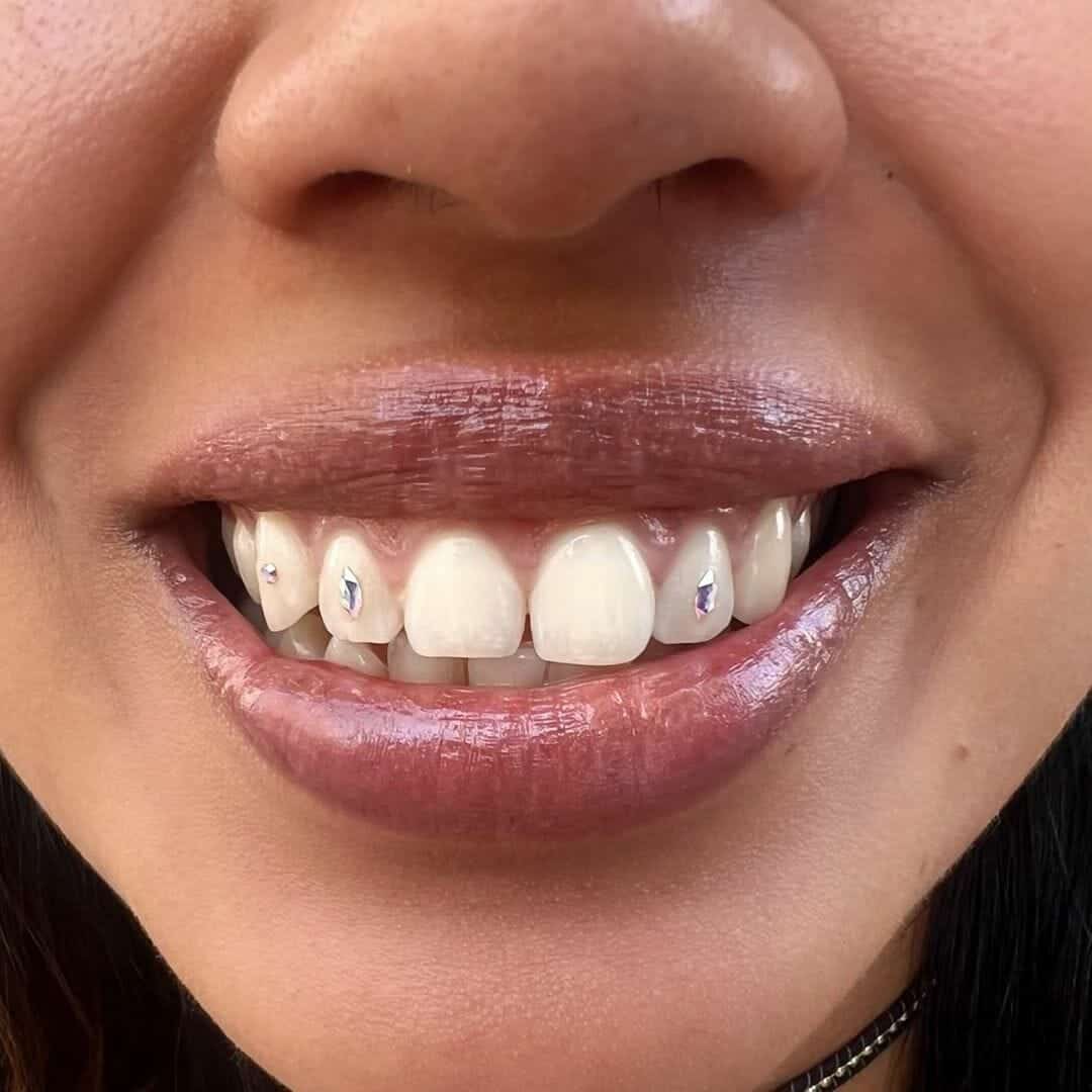 Gemas dentales – Grillz Madriz